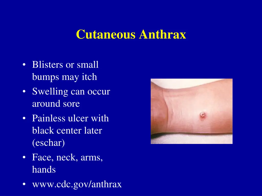 cutaneous anthrax