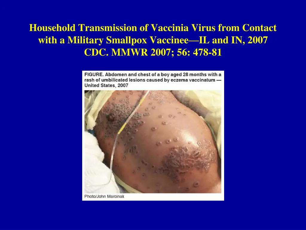 household transmission of vaccinia virus from