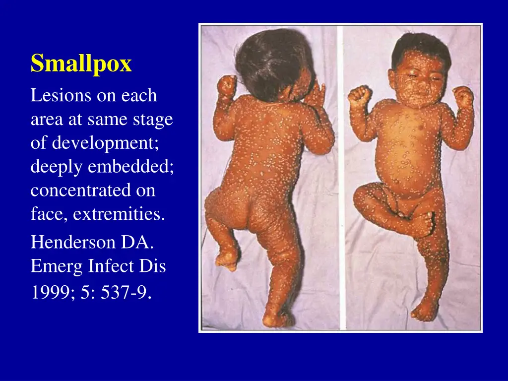 smallpox lesions on each area at same stage