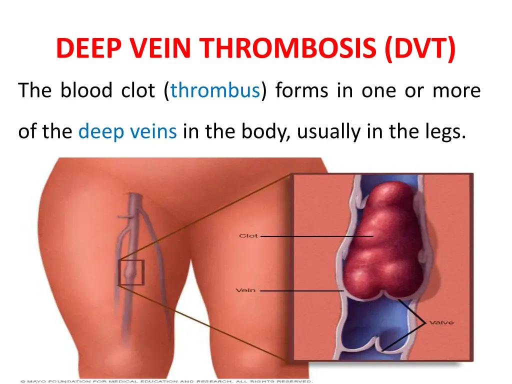 deep vein thrombosis dvt 1