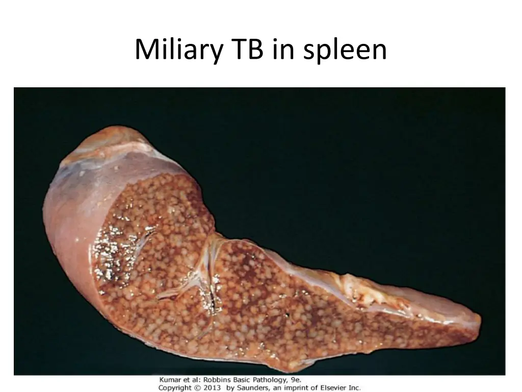 miliary tb in spleen