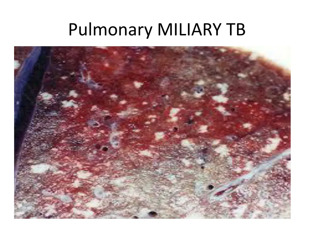 pulmonary miliary tb