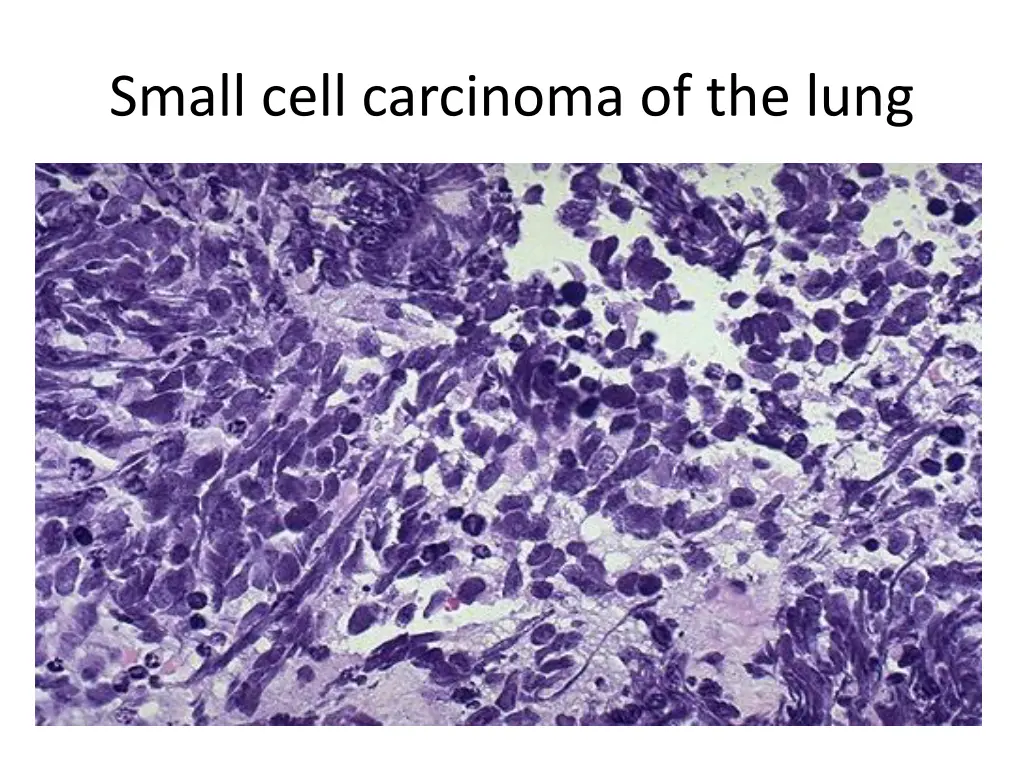 small cell carcinoma of the lung