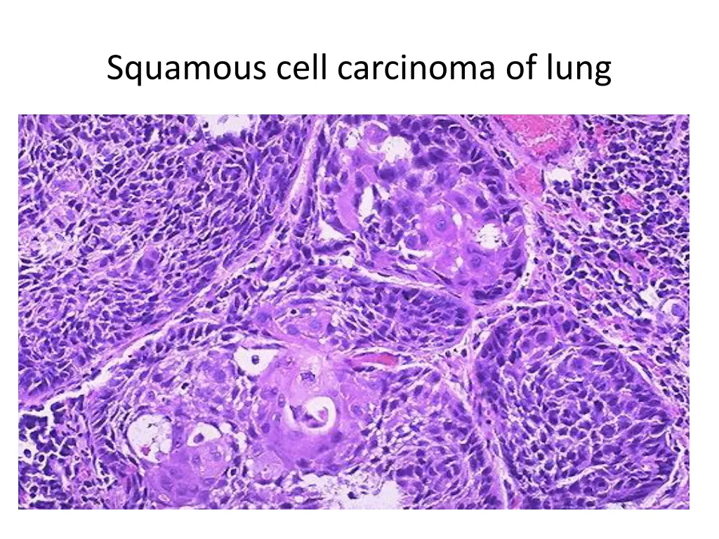 squamous cell carcinoma of lung