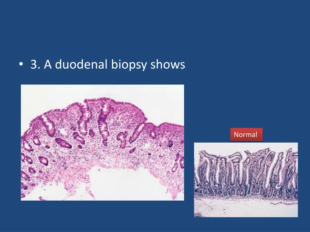 3 a duodenal biopsy shows