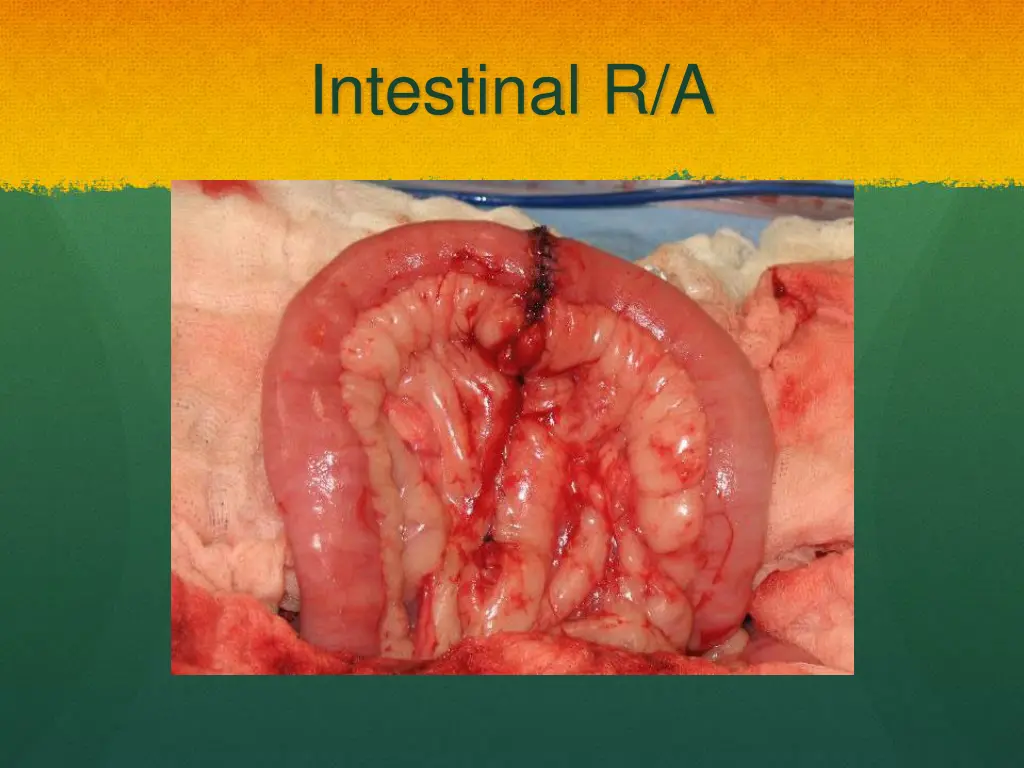 intestinal r a