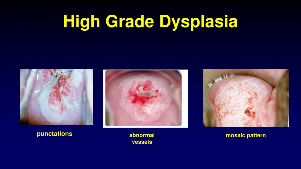 high grade dysplasia