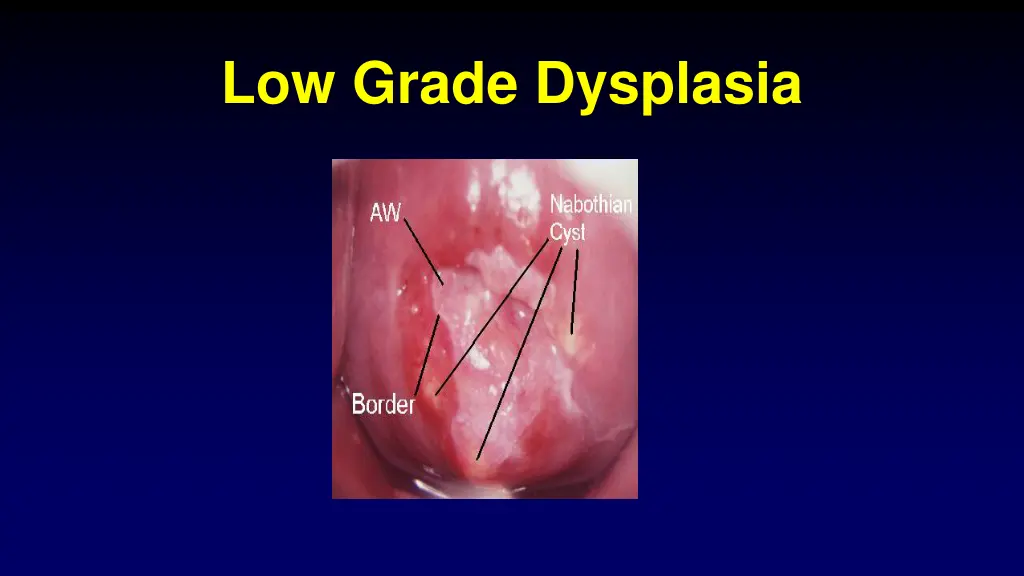 low grade dysplasia