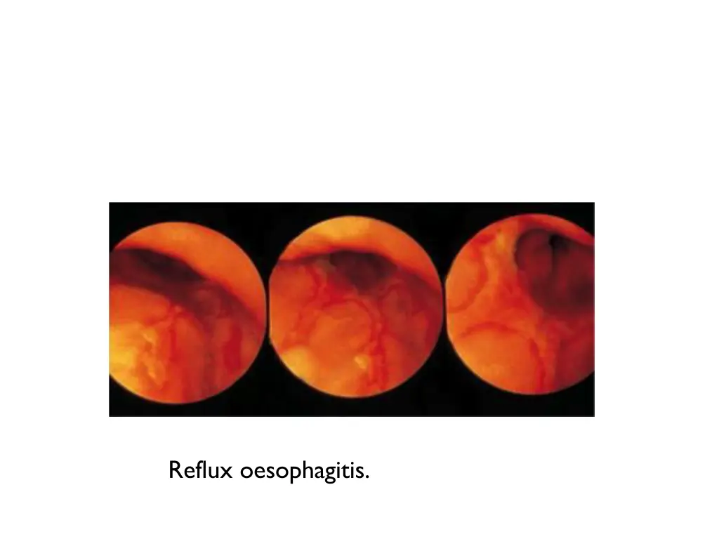 reflux oesophagitis