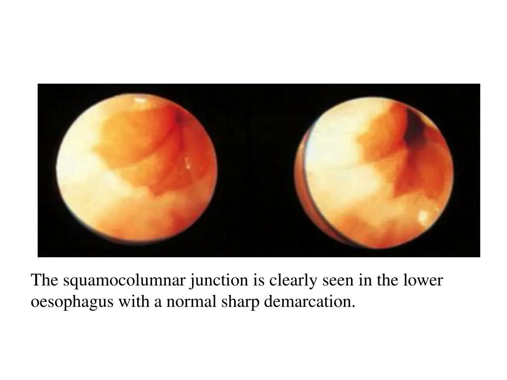 the squamocolumnar junction is clearly seen