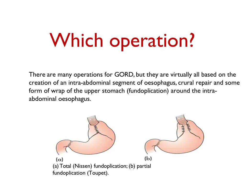 which operation