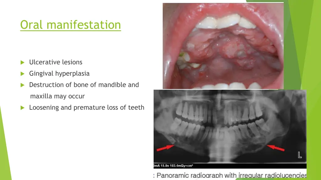 oral manifestation