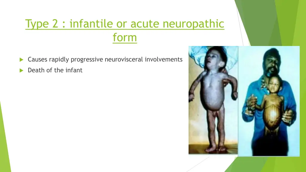type 2 infantile or acute neuropathic form