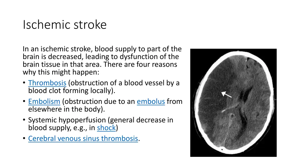 ischemic stroke
