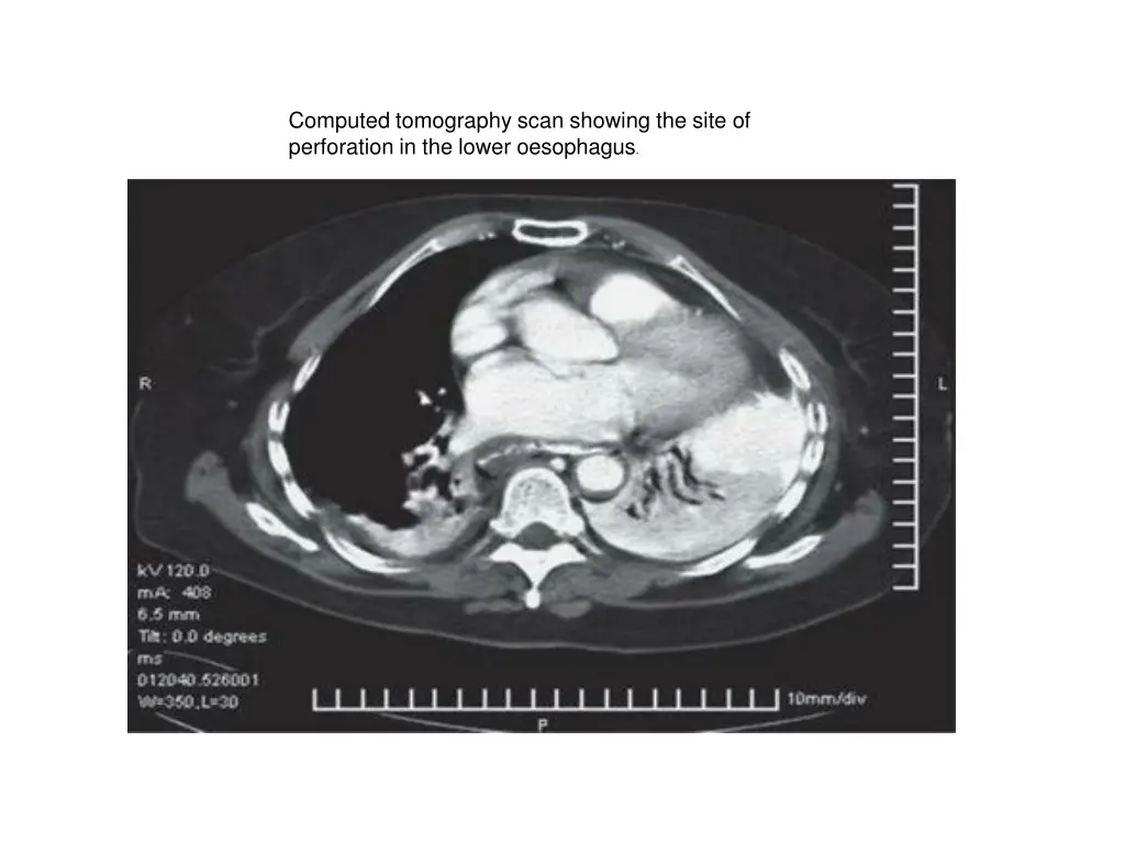 computed tomography scan showing the site