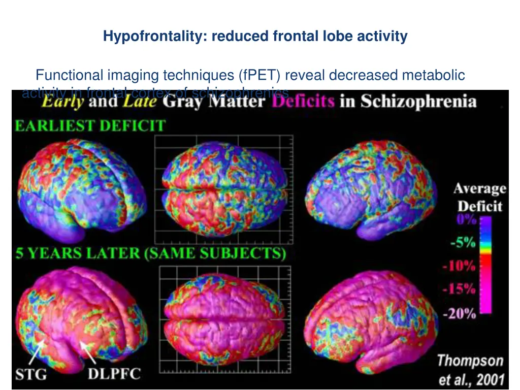 hypofrontality reduced frontal lobe activity