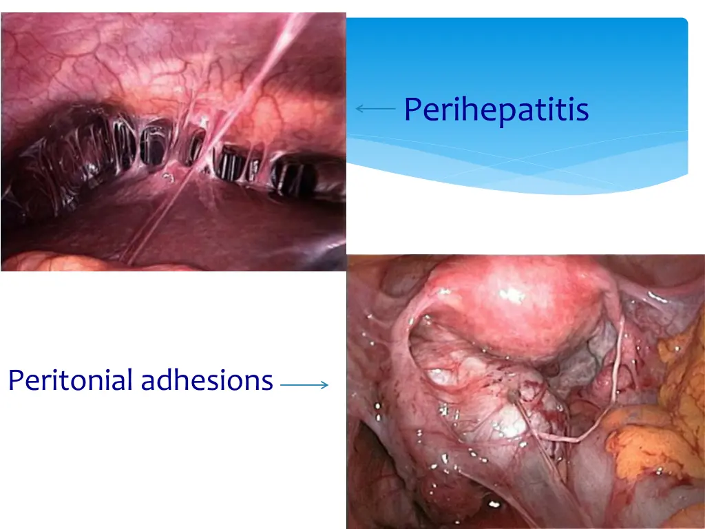 perihepatitis