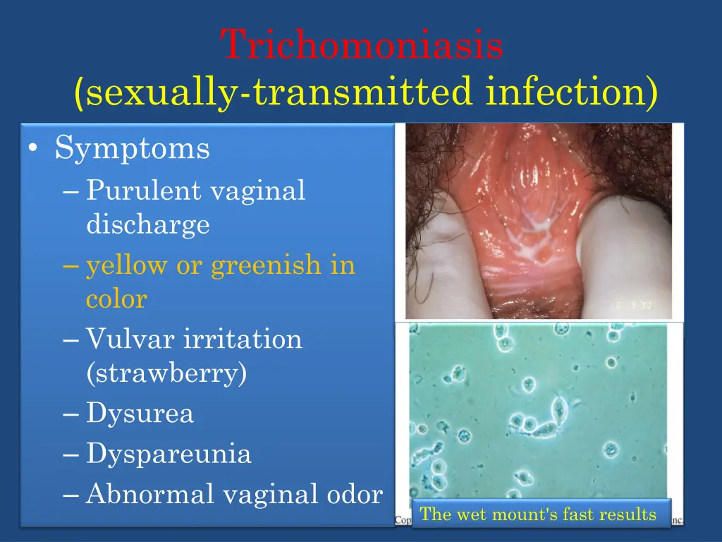 trichomoniasis