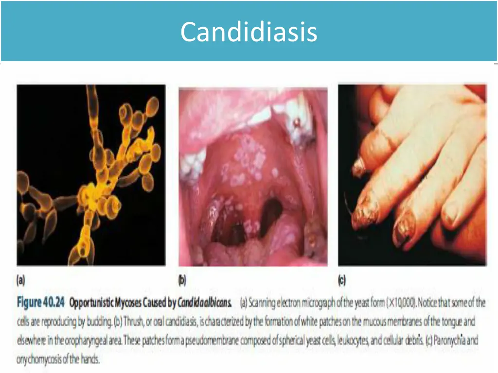 candidiasis 1