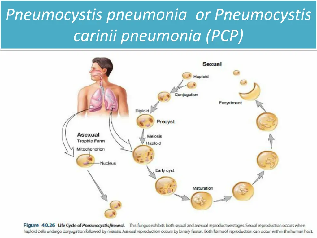 pneumocystis pneumonia or pneumocystis carinii