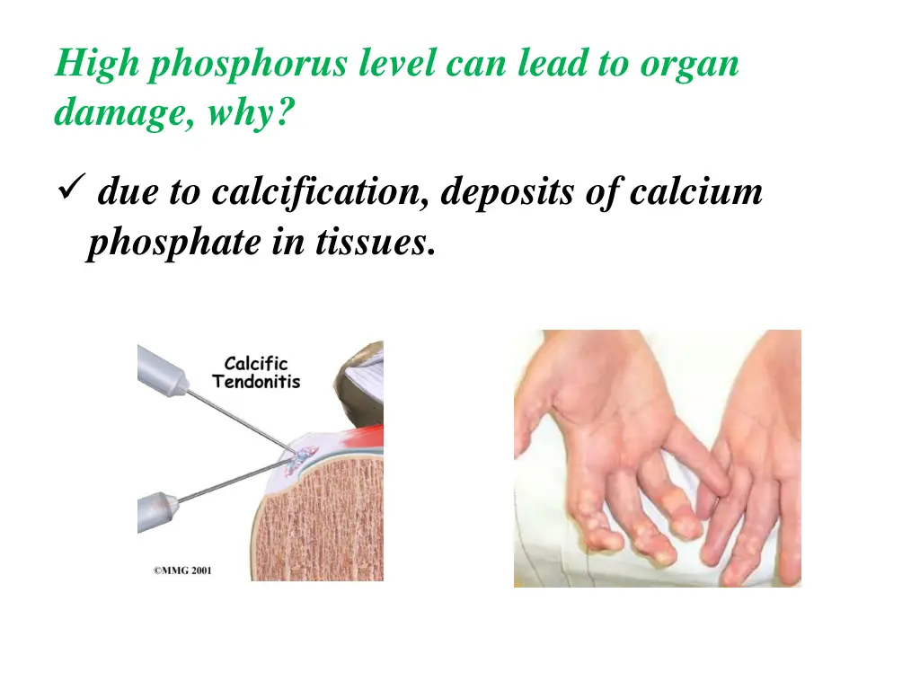 high phosphorus level can lead to organ damage why