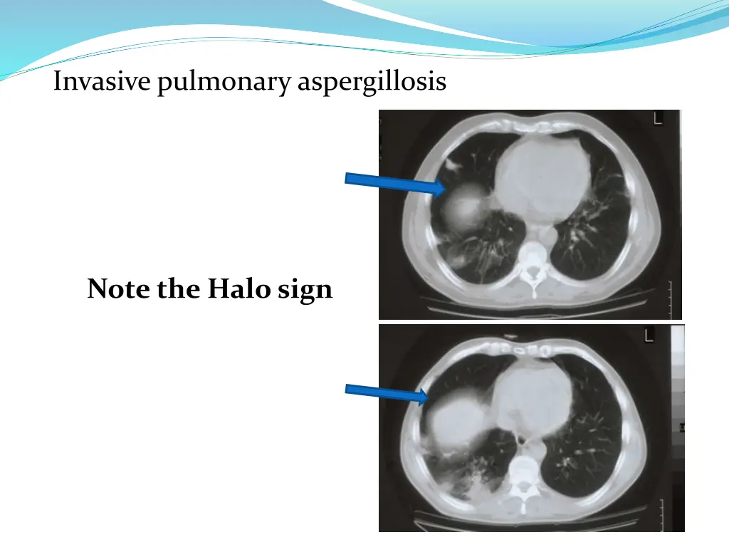 invasive pulmonary aspergillosis