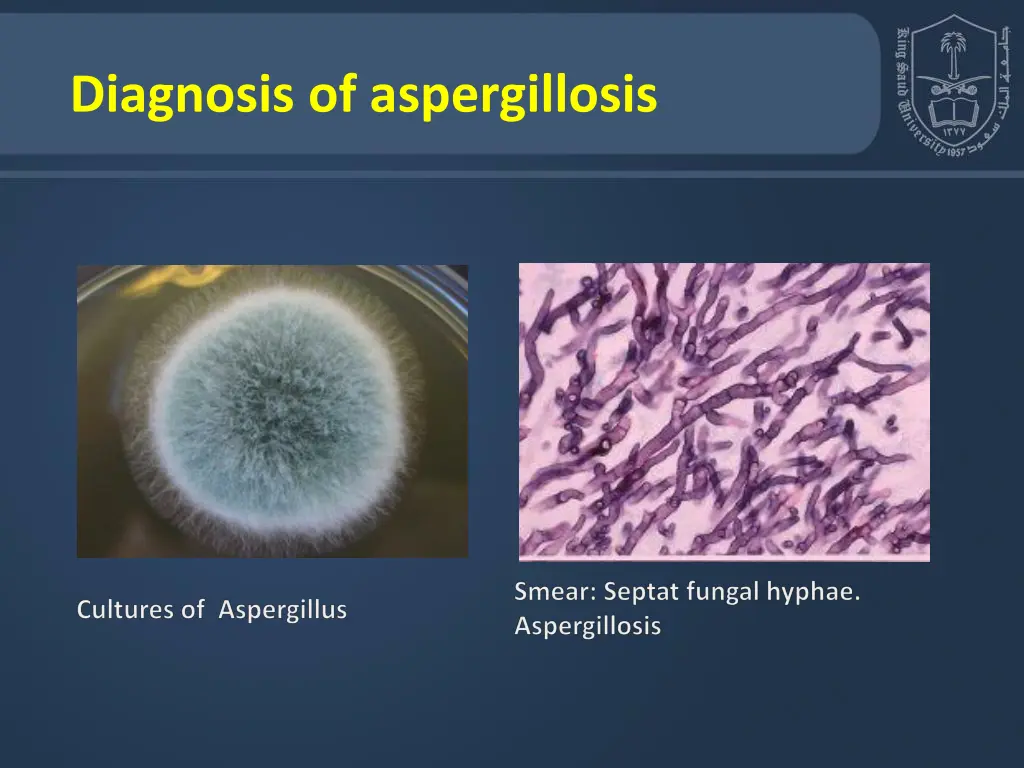 diagnosis of aspergillosis 1