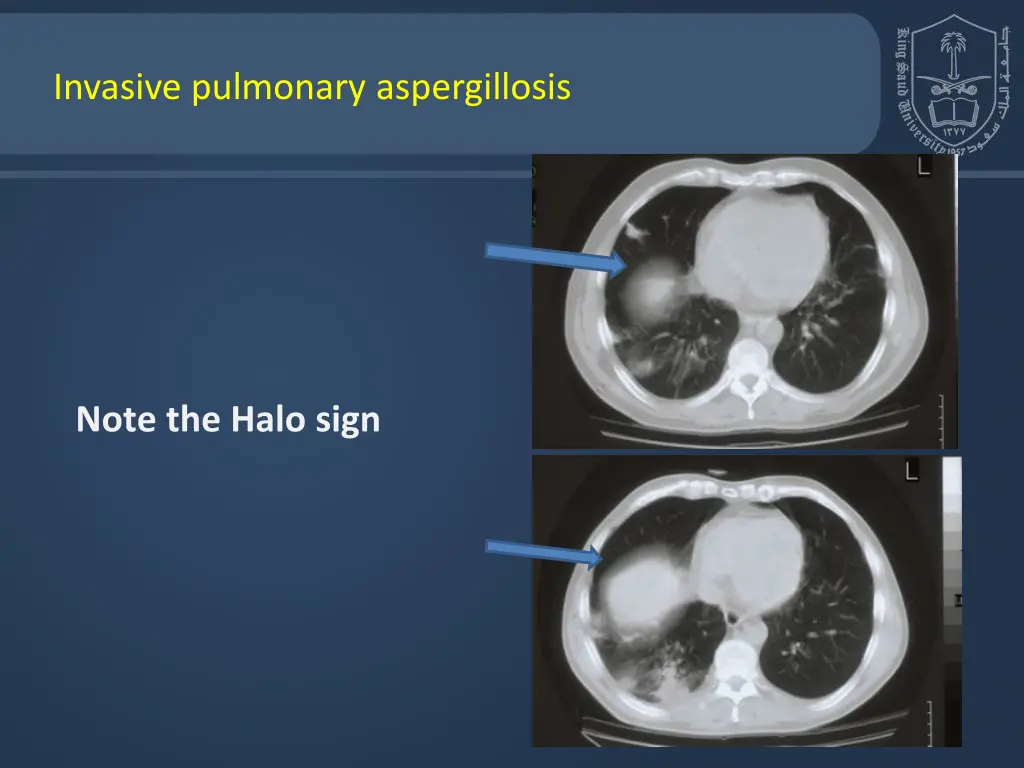 invasive pulmonary aspergillosis