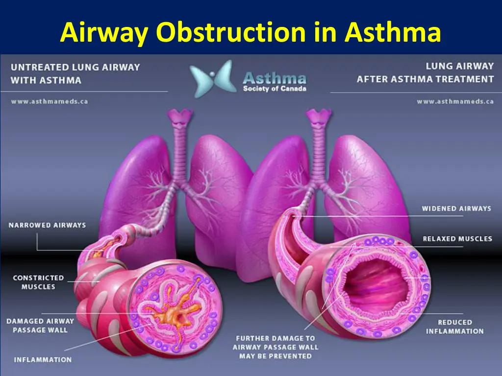 airway obstruction in asthma