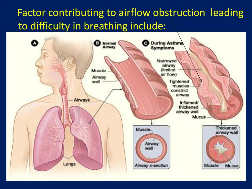 factor contributing to airflow obstruction