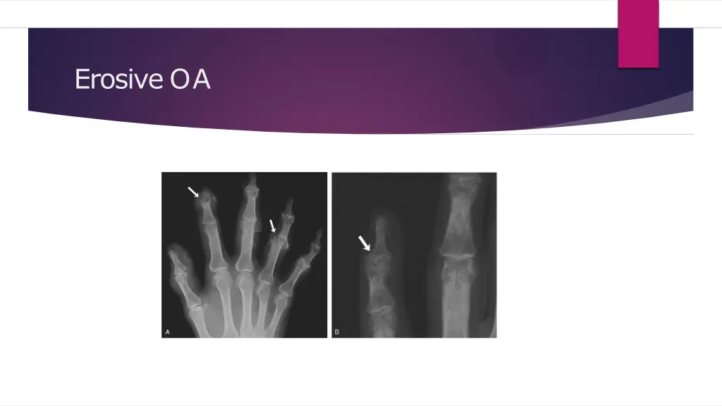 erosive oa