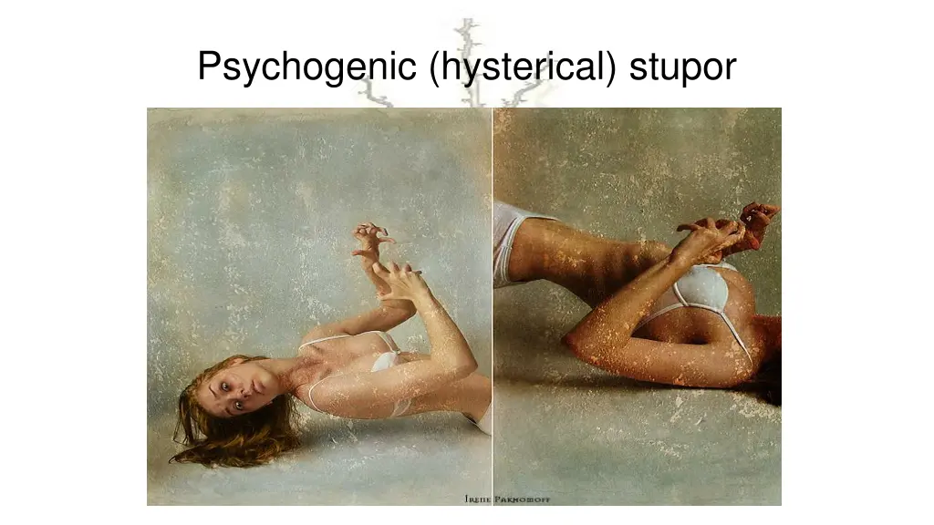 psychogenic hysterical stupor