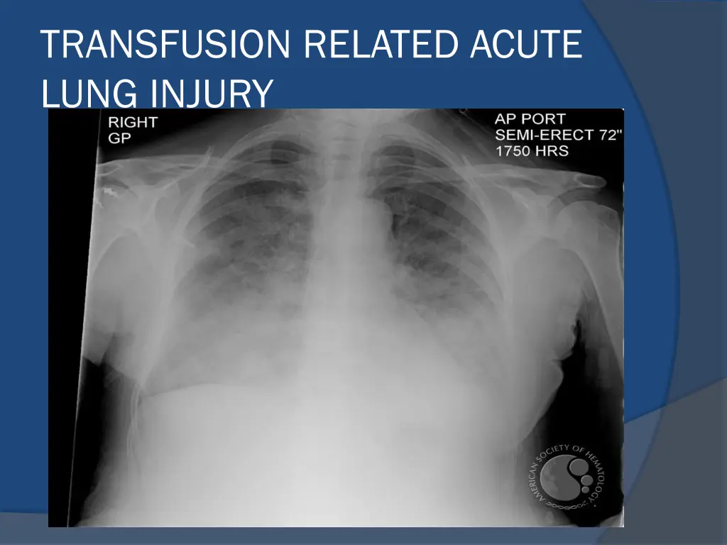 transfusion related acute lung injury