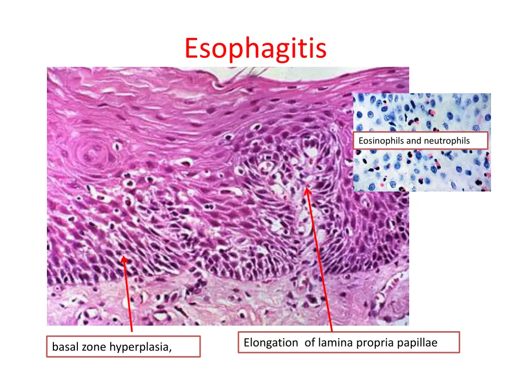 esophagitis