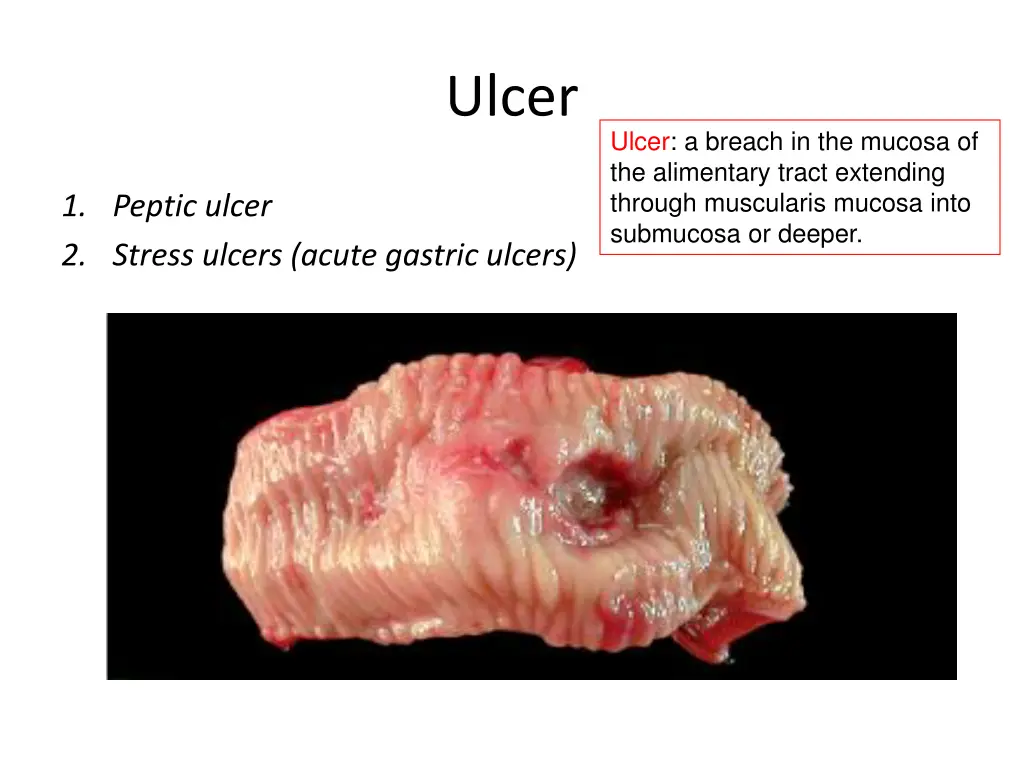 ulcer