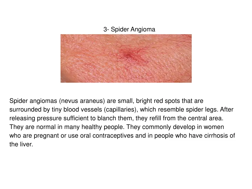 3 spider angioma