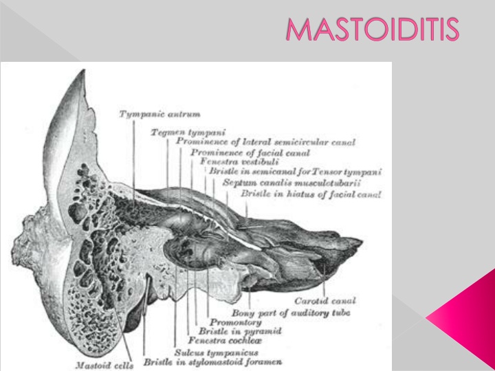 mastoiditis