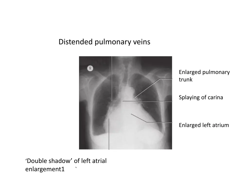 distended pulmonary veins