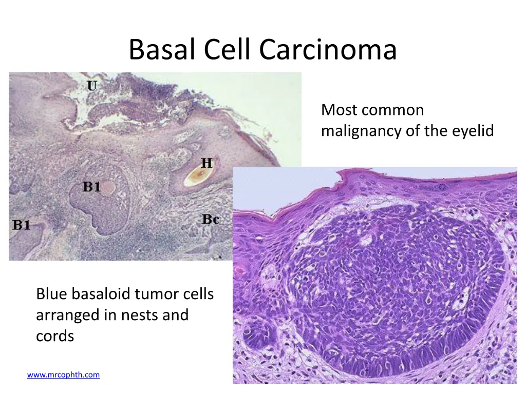 basal cell carcinoma