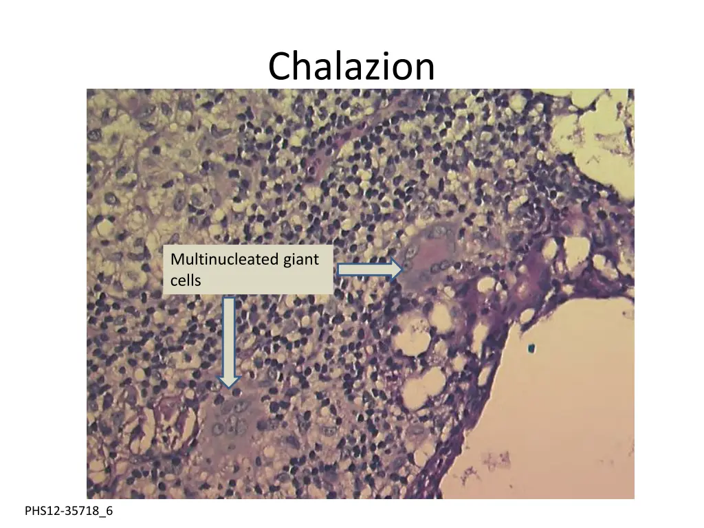chalazion 1