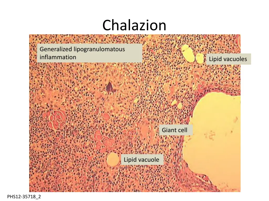 chalazion 2