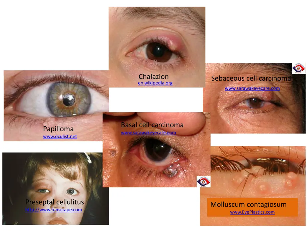 chalazion en wikipedia org