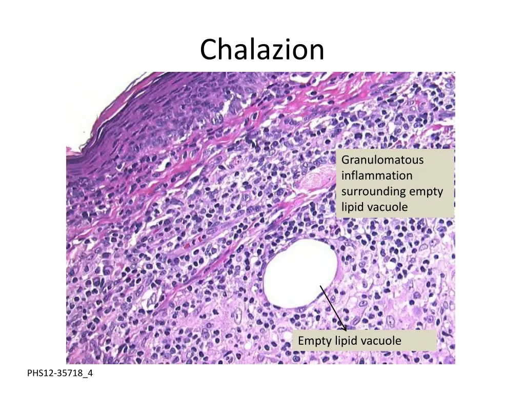 chalazion