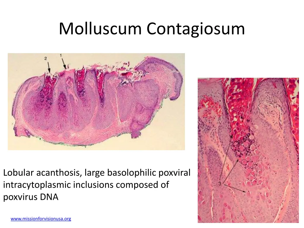 molluscum contagiosum