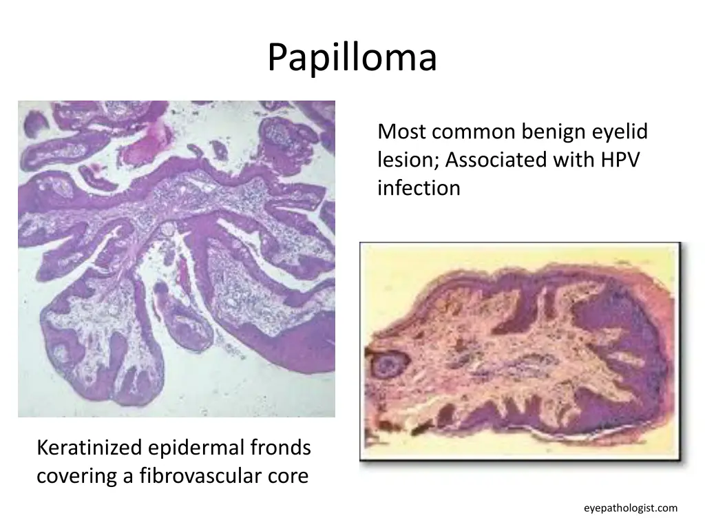 papilloma