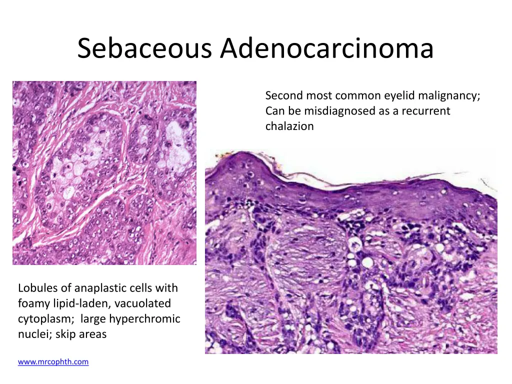 sebaceous adenocarcinoma