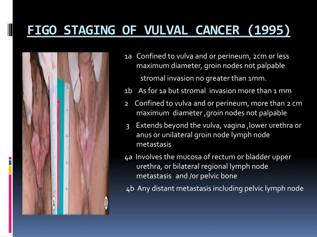figo staging of vulval cancer 1995