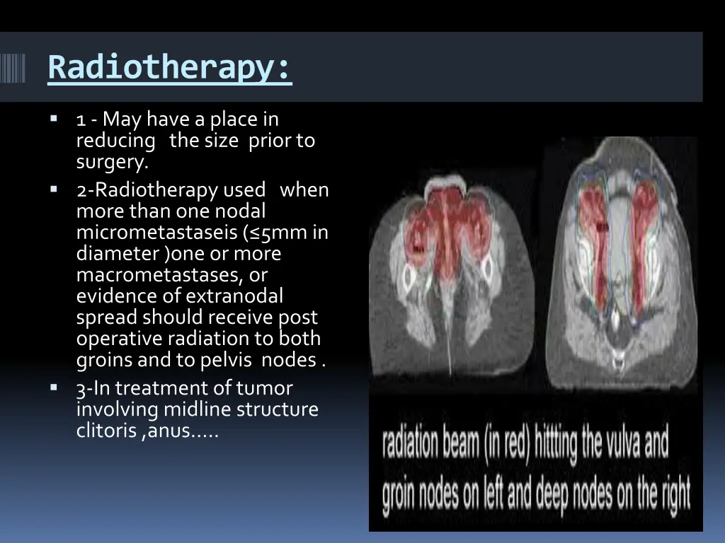 radiotherapy