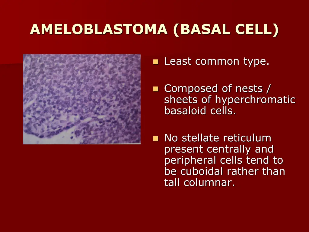 ameloblastoma basal cell