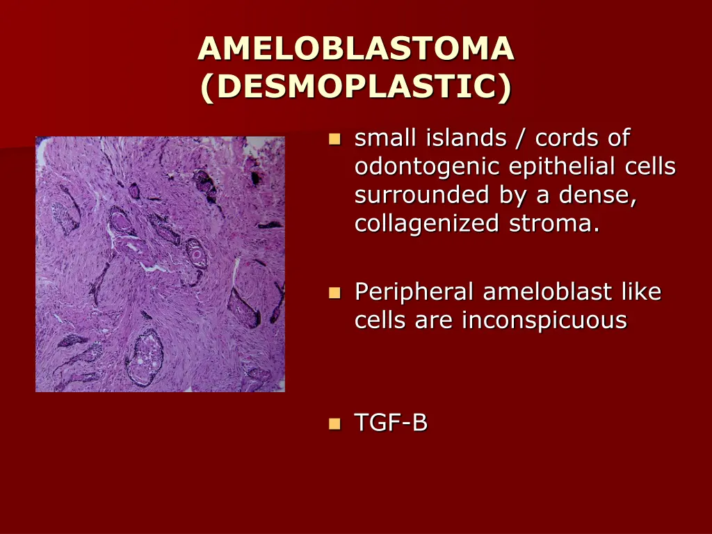 ameloblastoma desmoplastic